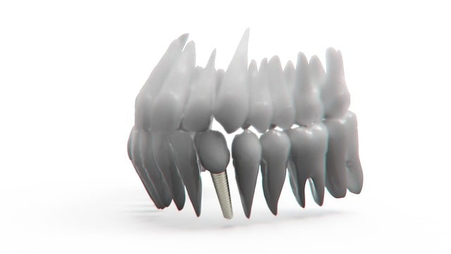 dental implants mcallen