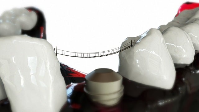 dental implants mcallen tx