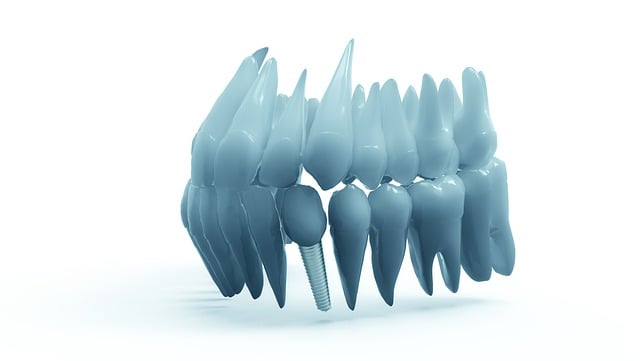 How do I prepare for a dental implant procedure in McAllen